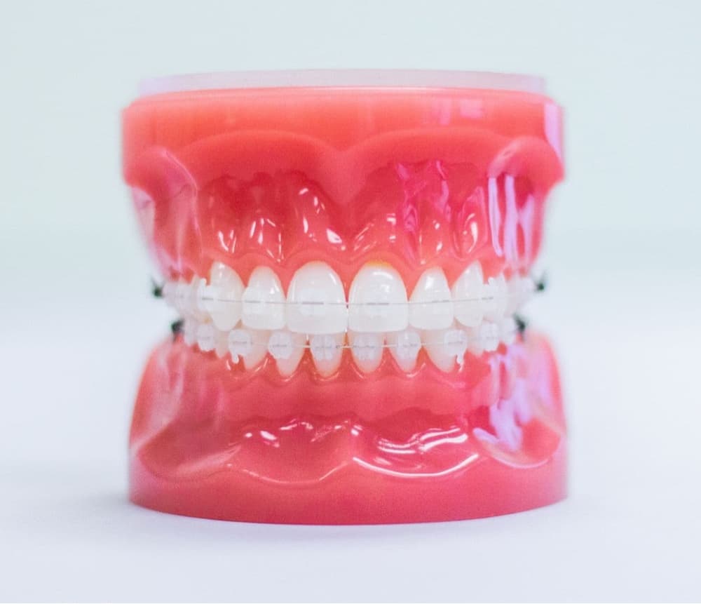 ceramic braces on plastic model