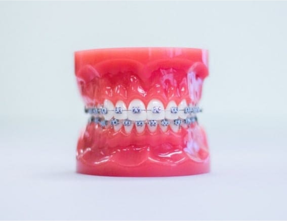 metal braces on plastic model