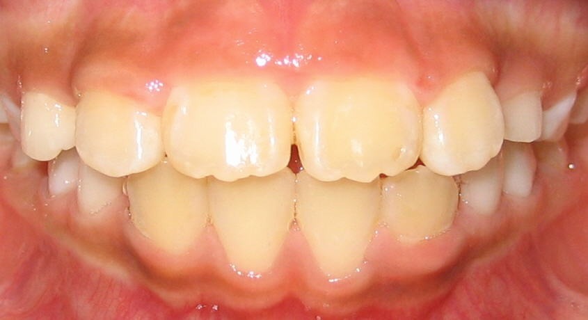 Orthodontic Before & After Photo