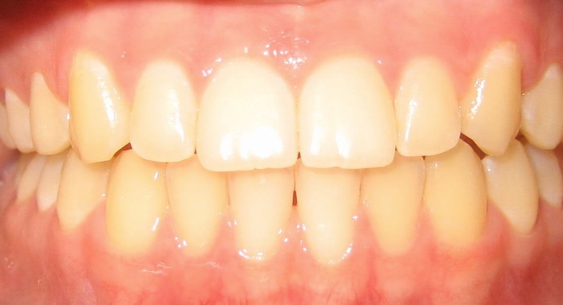 Orthodontic Before & After Photo