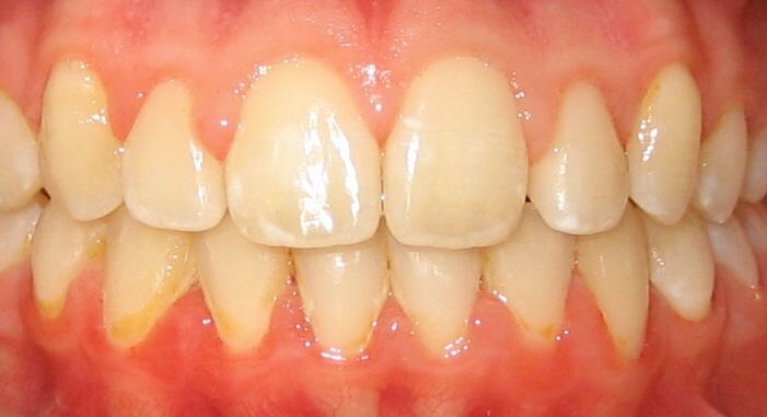 Orthodontic Before & After Photo