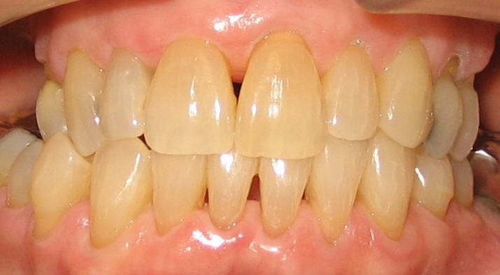 Orthodontic Before & After Photo