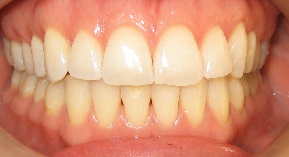 Orthodontic Before & After Photo