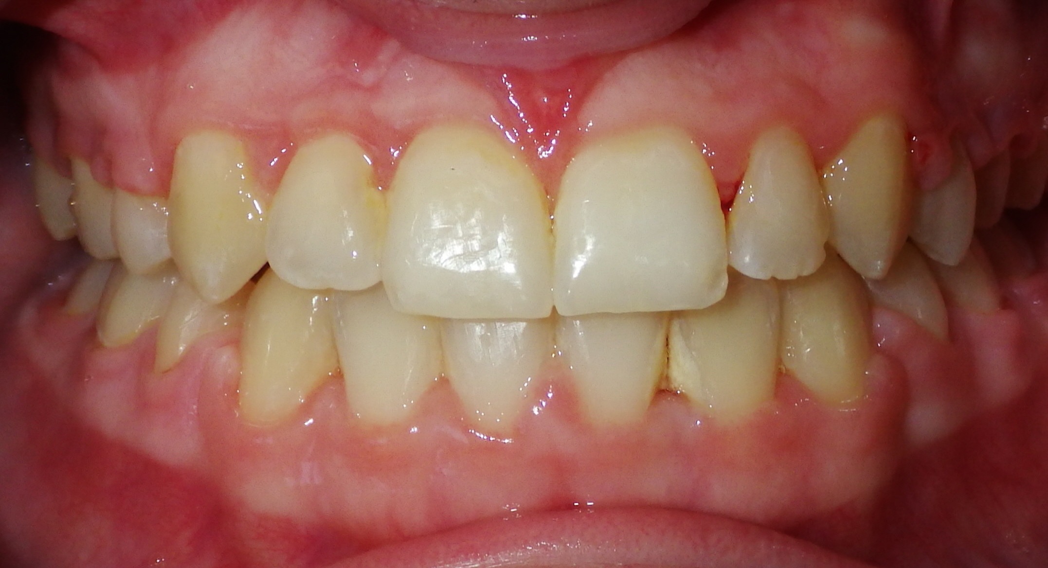 Orthodontic Before & After Photo