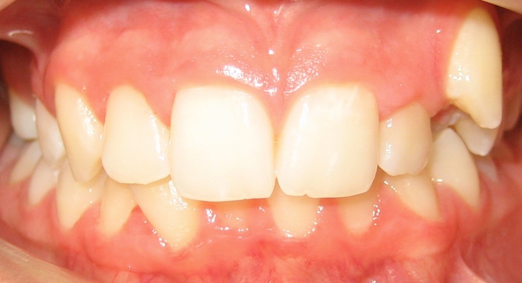 before 3 Orthodontic Before & After Photo
