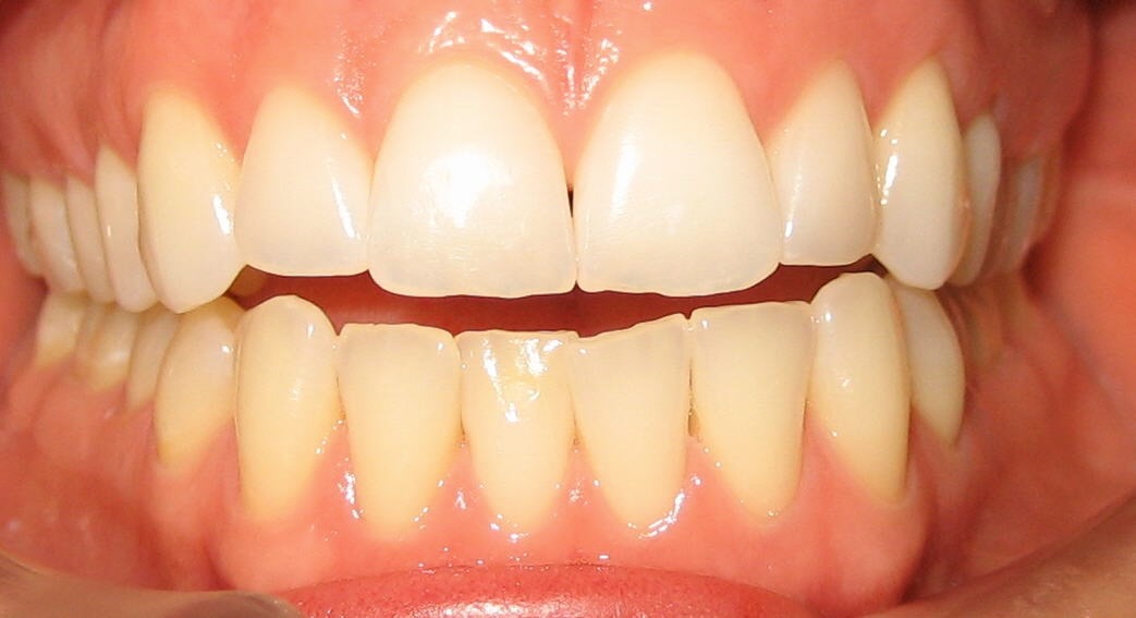 Orthodontic Before & After Photo