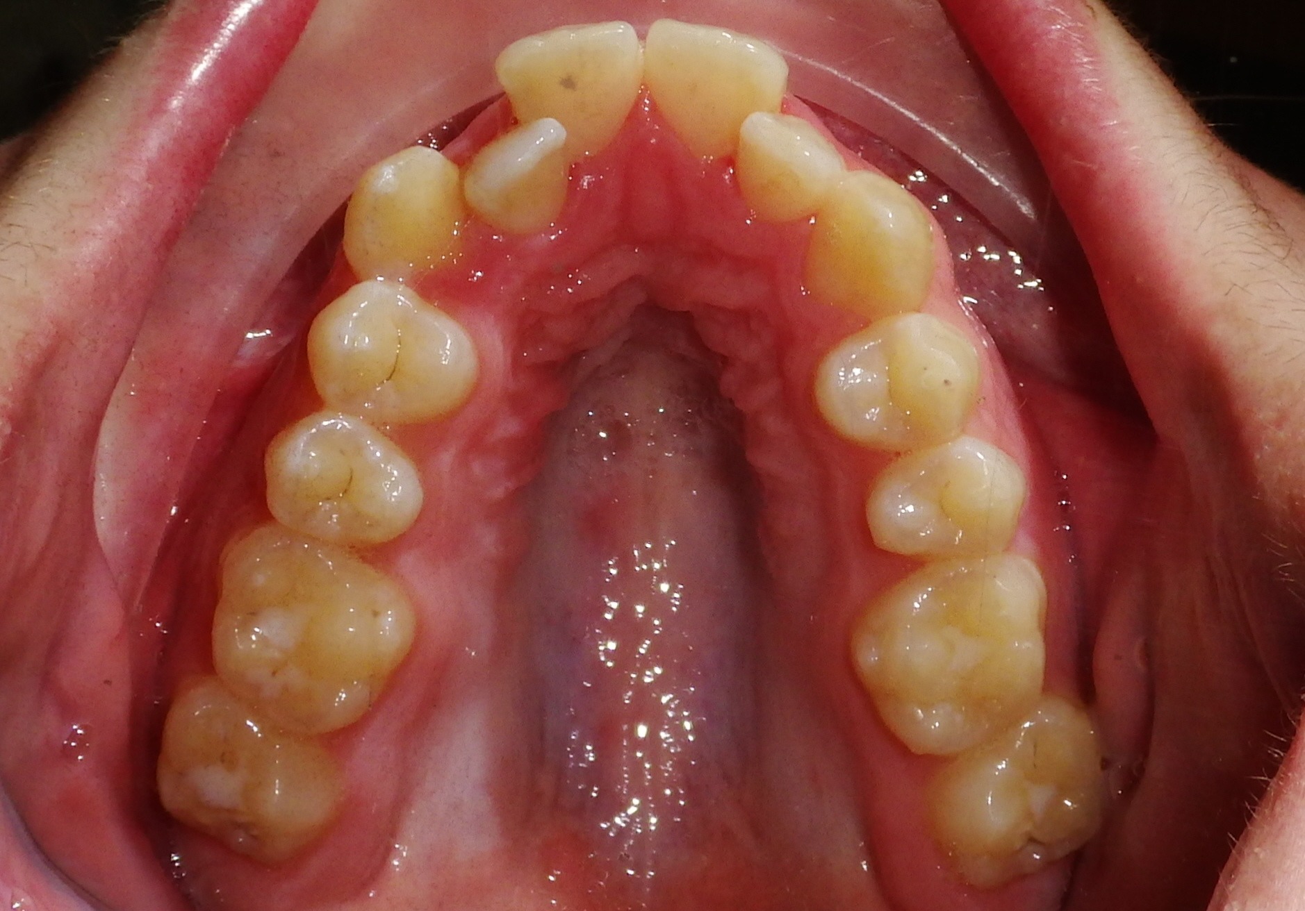 Orthodontic Before & After Photo