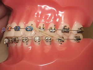 How Long to Wear Rubber Bands for Braces