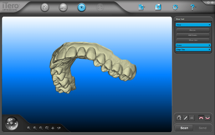 Itero scans of teeth