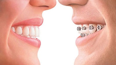 What is the difference in cost between braces and Invisalign?